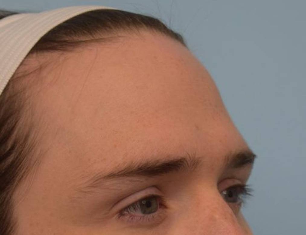 Hairline Advancement Before & After Image