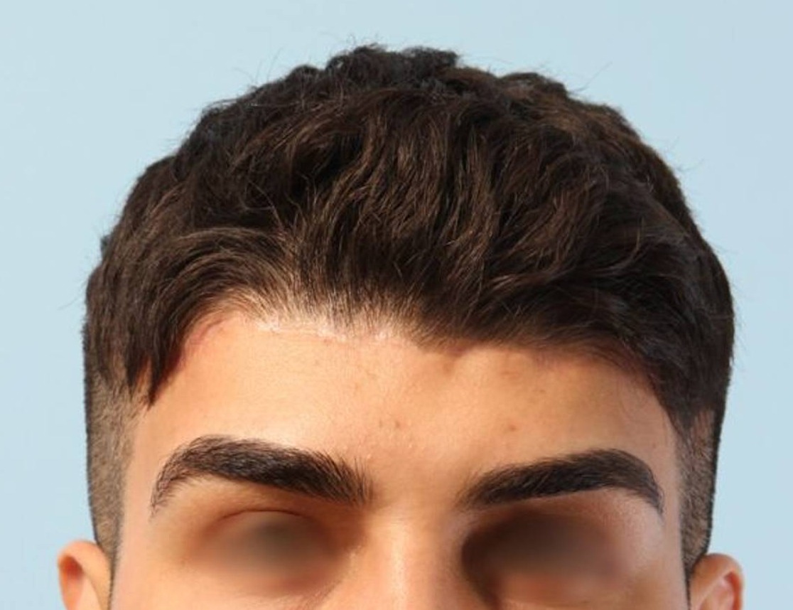 Hairline Advancement Before & After Image