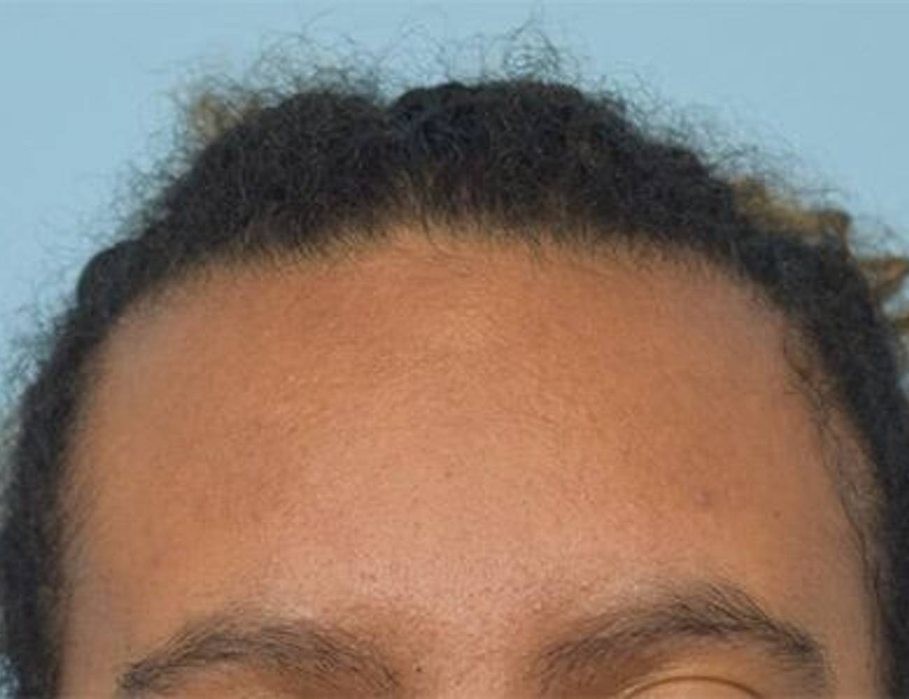 Hairline Advancement Before & After Image