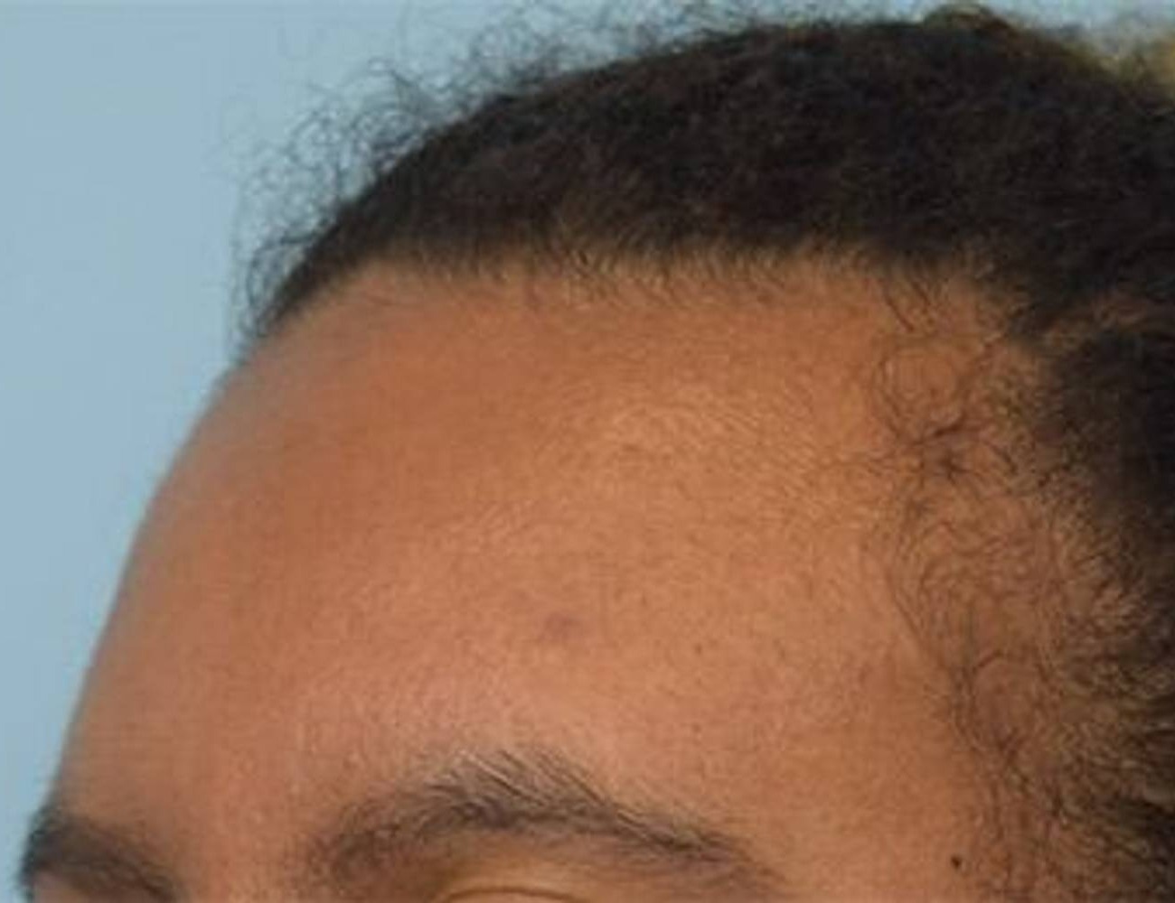 Hairline Advancement Before & After Image