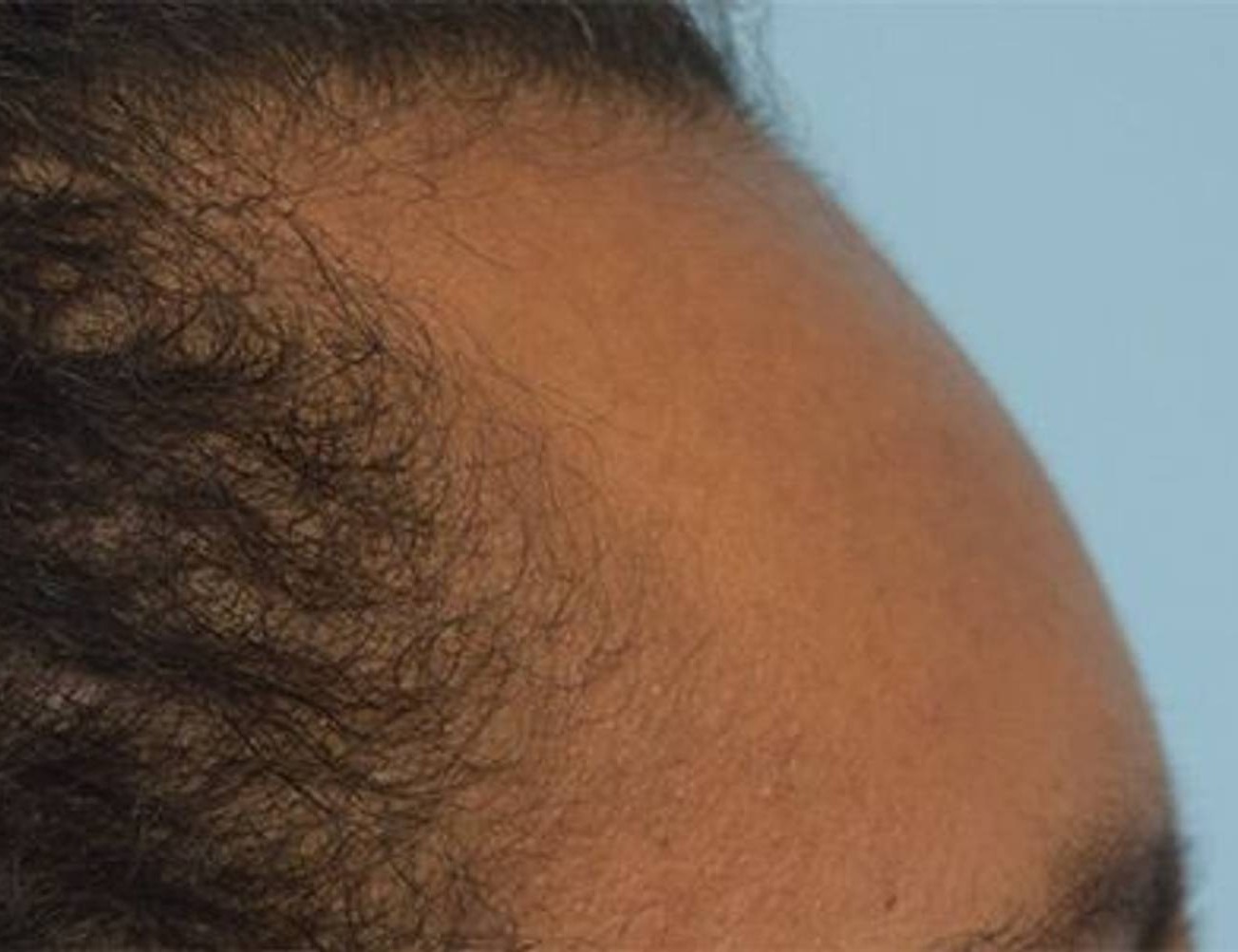 Hairline Advancement Before & After Image