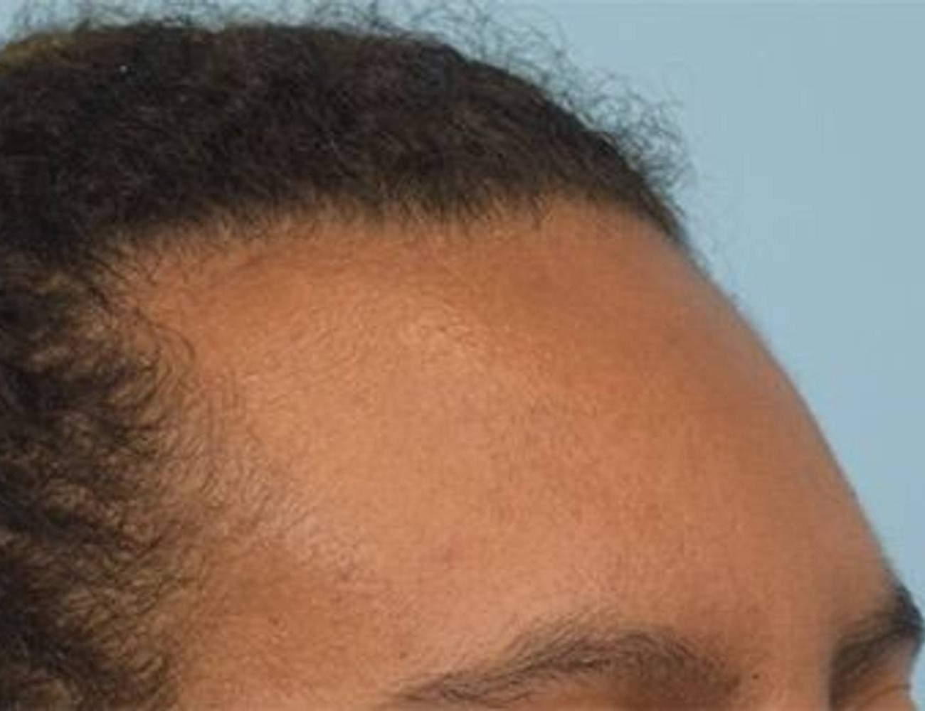 Hairline Advancement Before & After Image