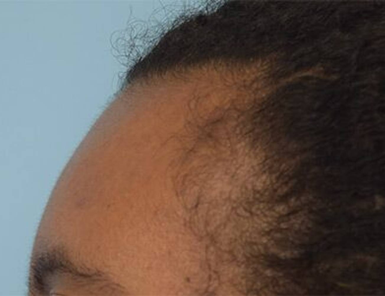 Hairline Advancement Before & After Image