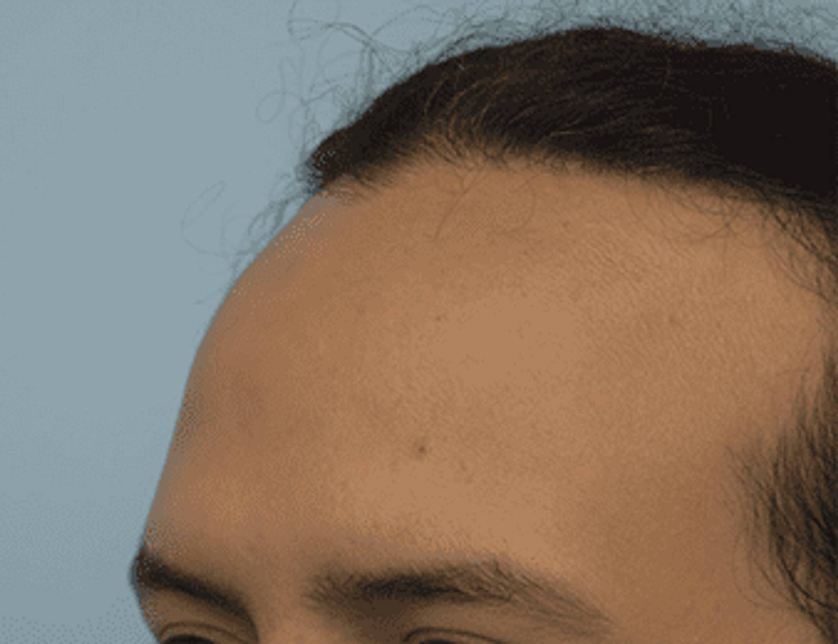 Hairline Advancement Before & After Image