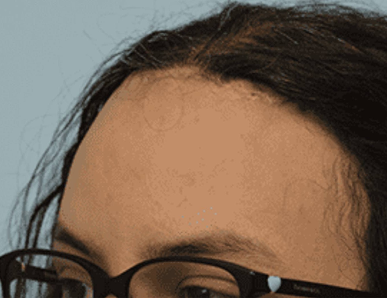 Hairline Advancement Before & After Image