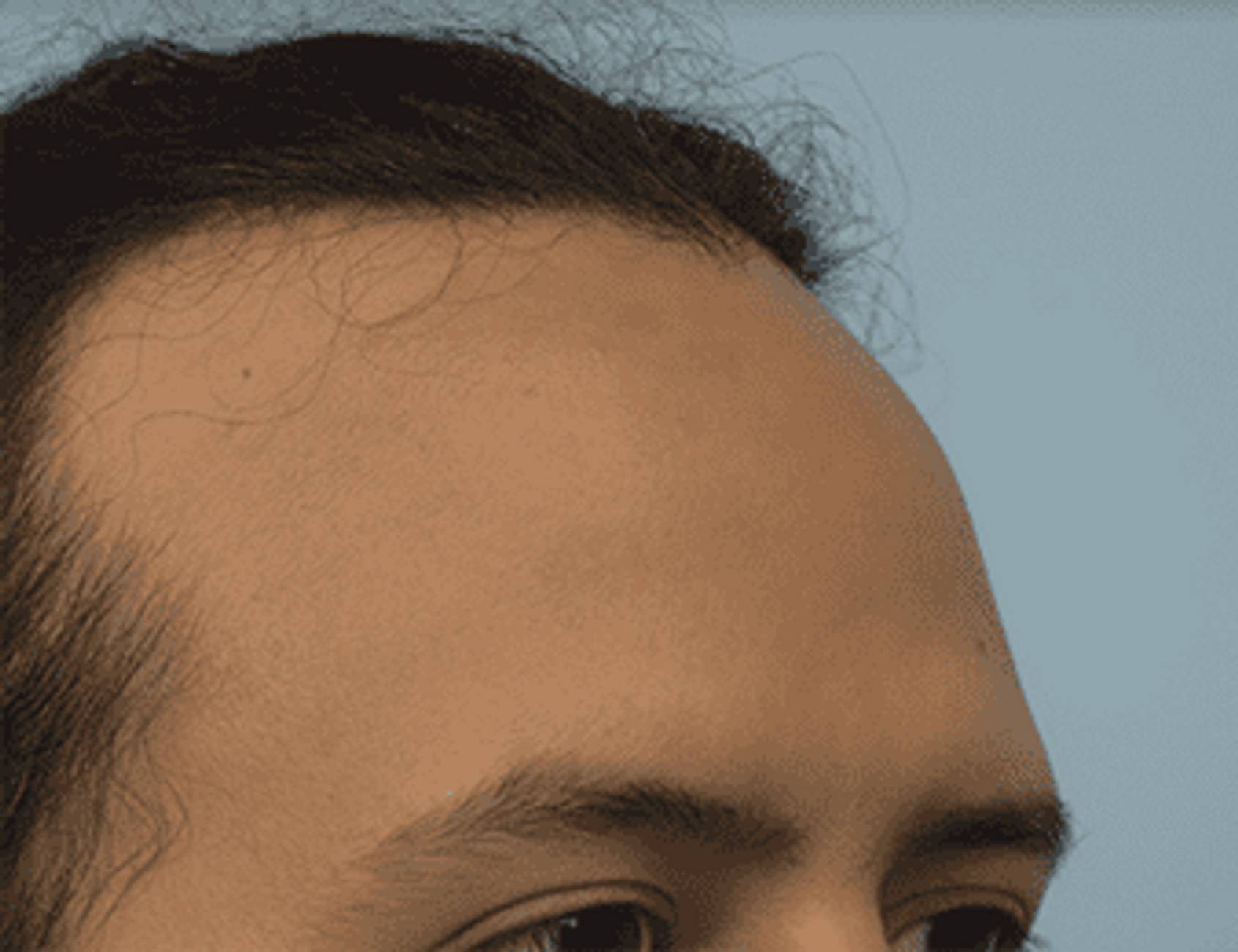 Hairline Advancement Before & After Image