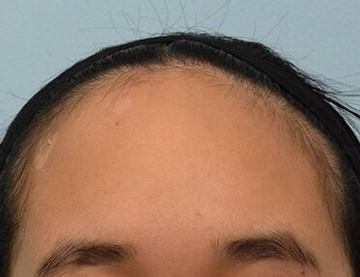 Hairline Advancement Before & After Image