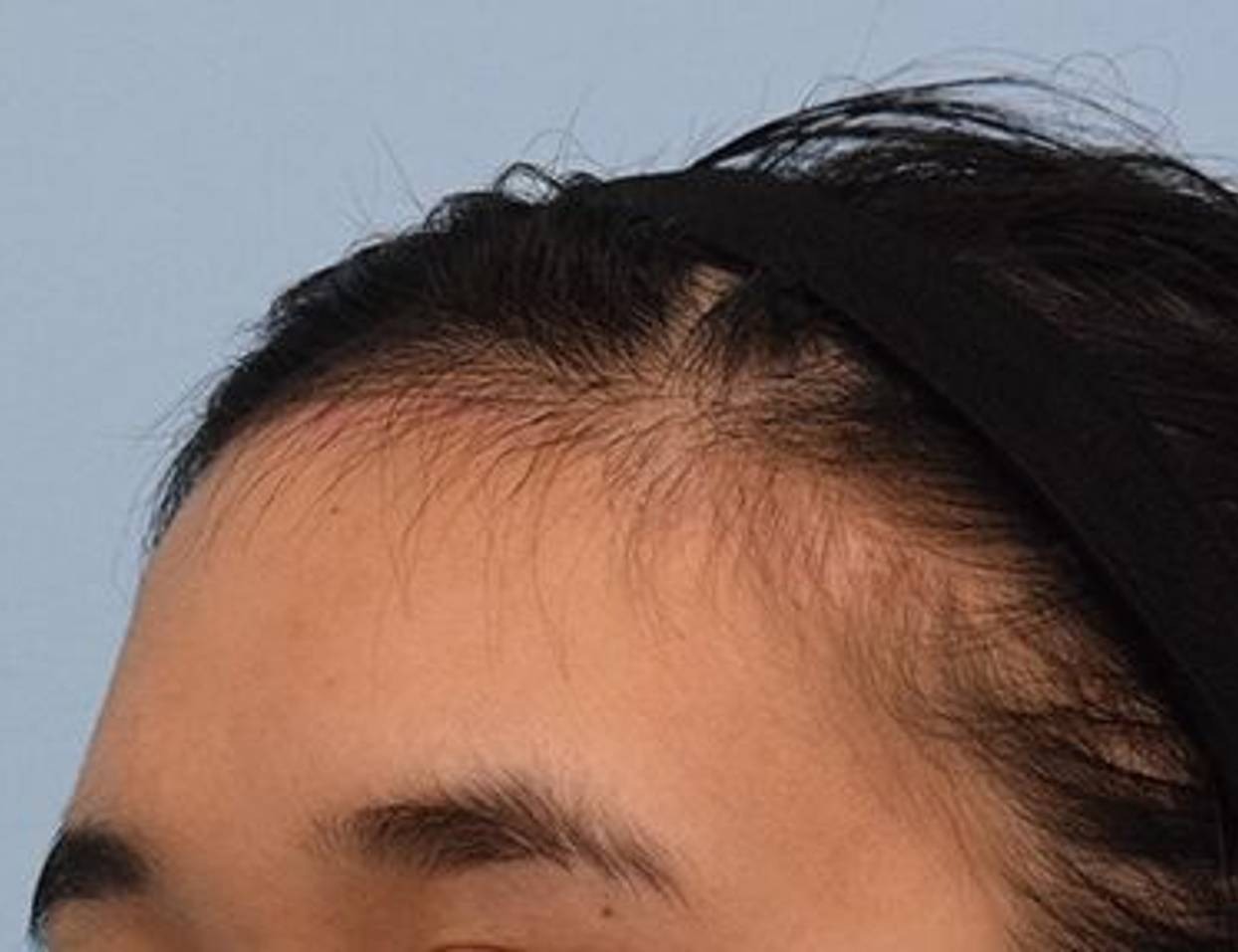 Hairline Advancement Before & After Image