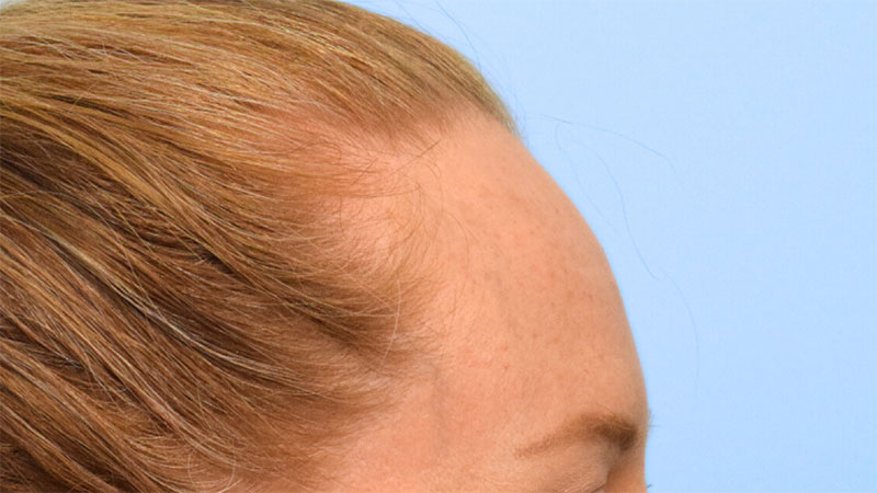 Hairline Advancement Before & After Image