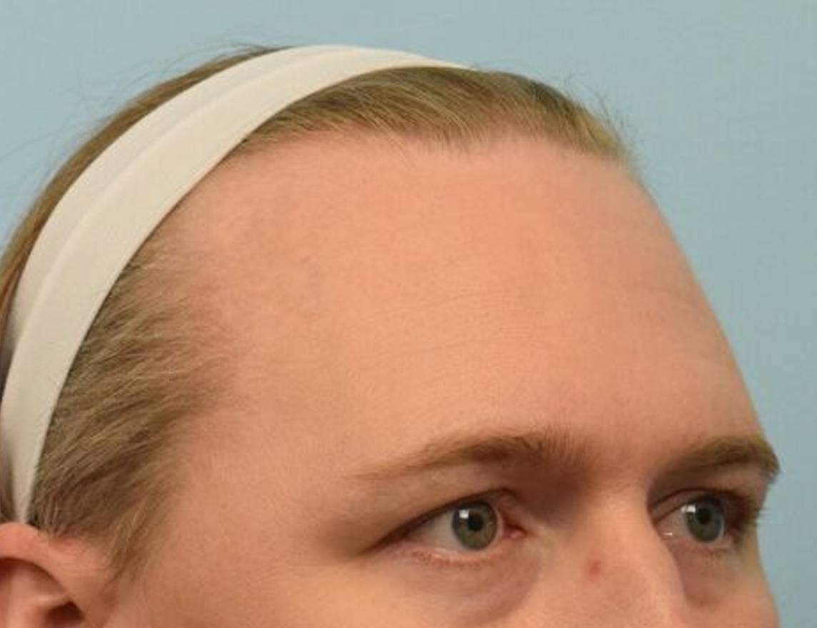 Hairline Advancement Before & After Image