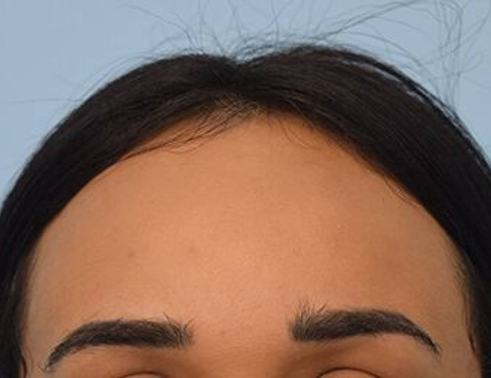 Hairline Advancement Before & After Image