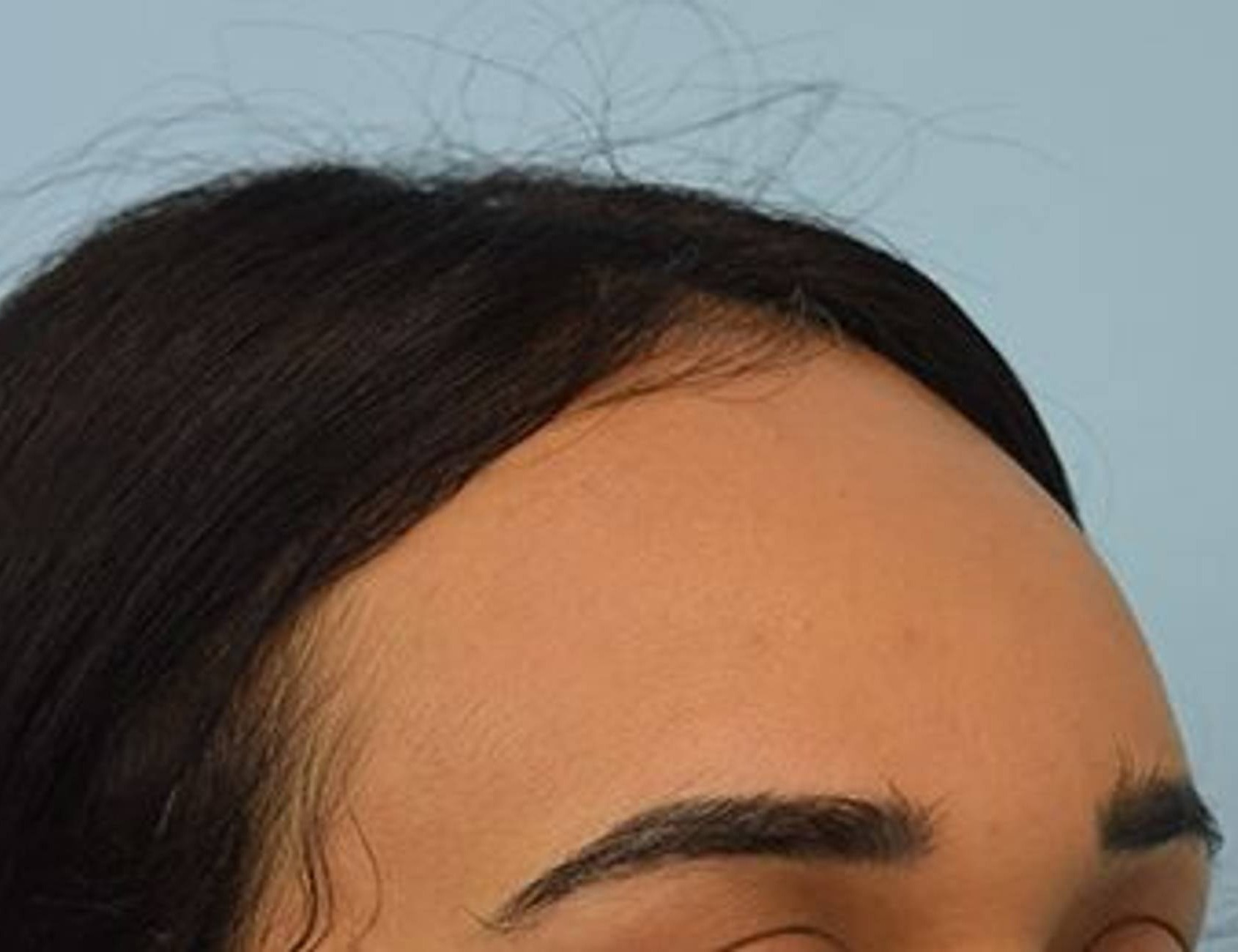 Hairline Advancement Before & After Image