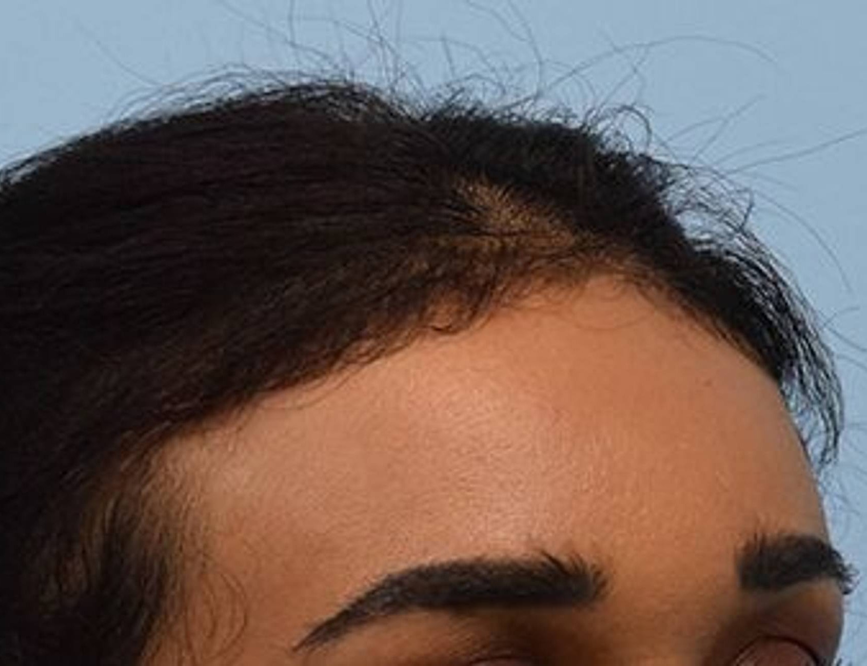 Hairline Advancement Before & After Image