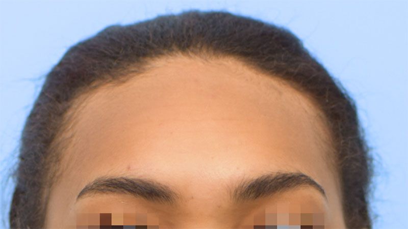 Hairline Advancement Before & After Image