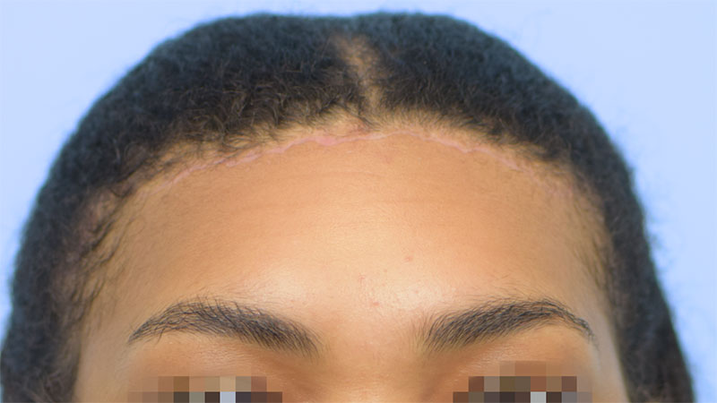 Hairline Advancement Before & After Image