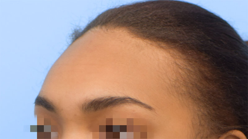 Hairline Advancement Before & After Image