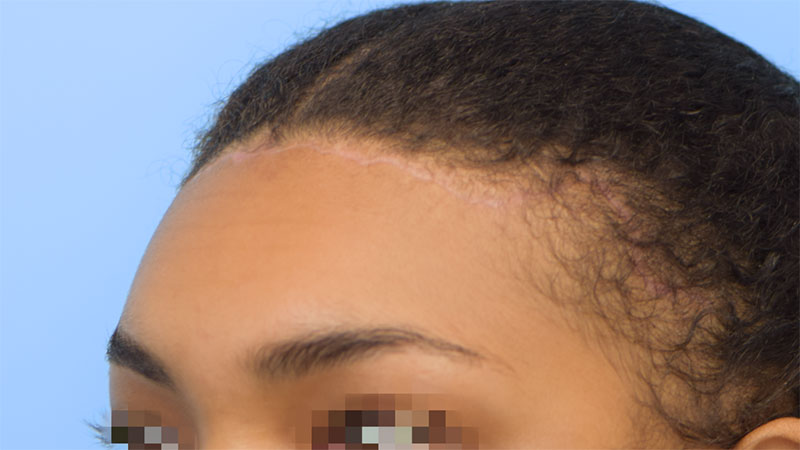 Hairline Advancement Before & After Image