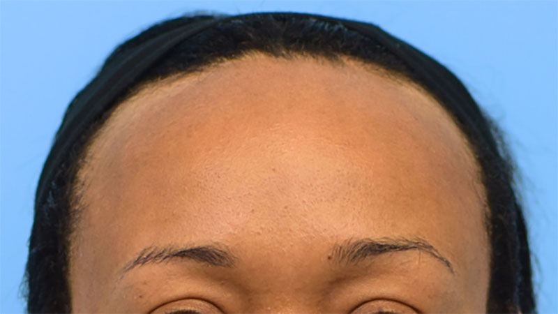 Hairline Advancement Before & After Image