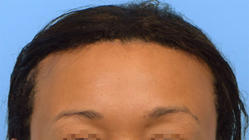 Hairline Advancement Before & After Image