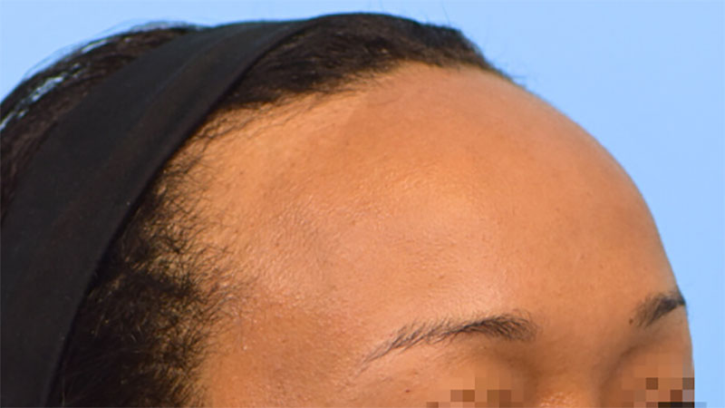 Hairline Advancement Before & After Image