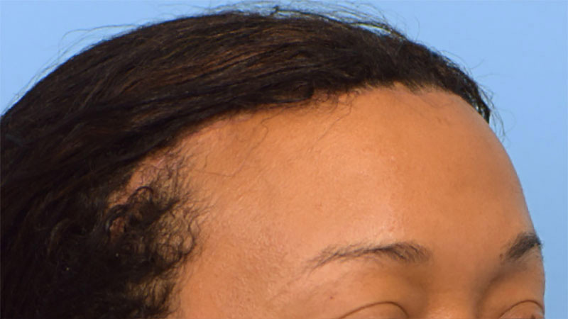 Hairline Advancement Before & After Image