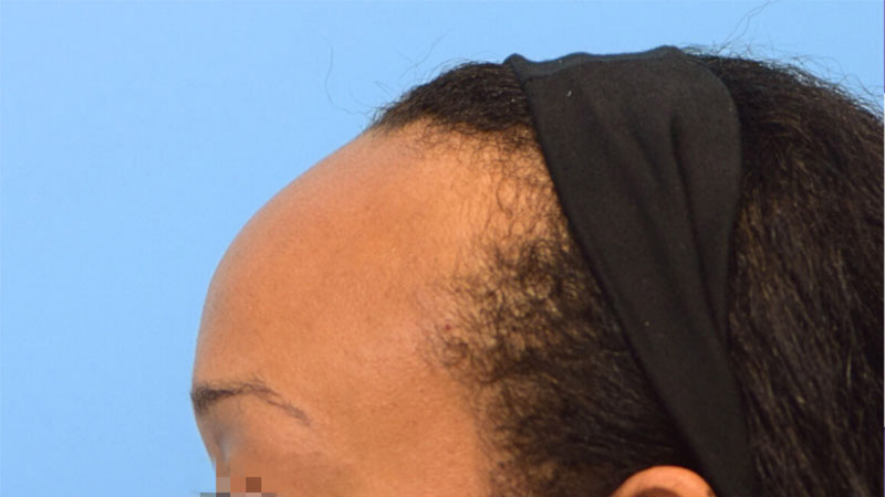 Hairline Advancement Before & After Image