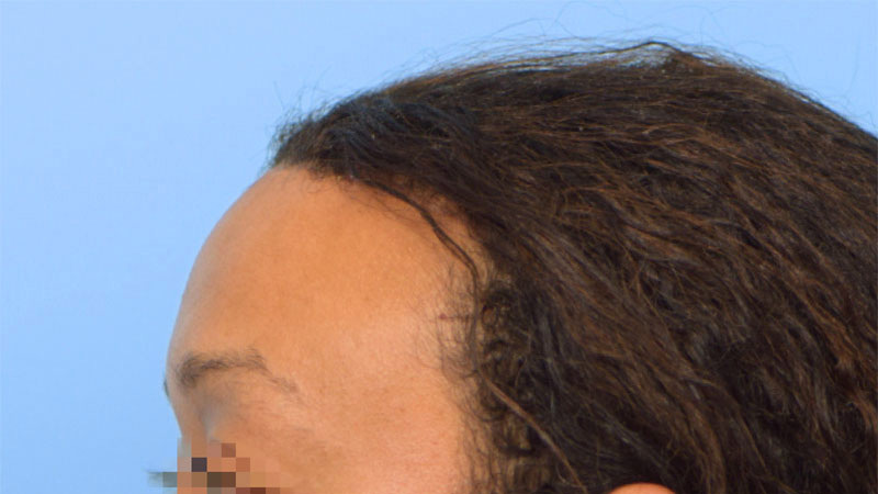 Hairline Advancement Before & After Image