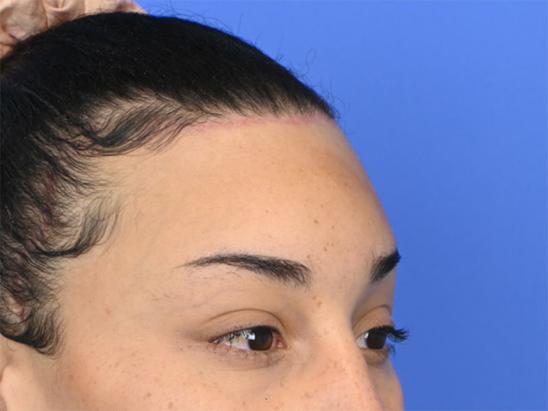 Hairline Advancement Before & After Image