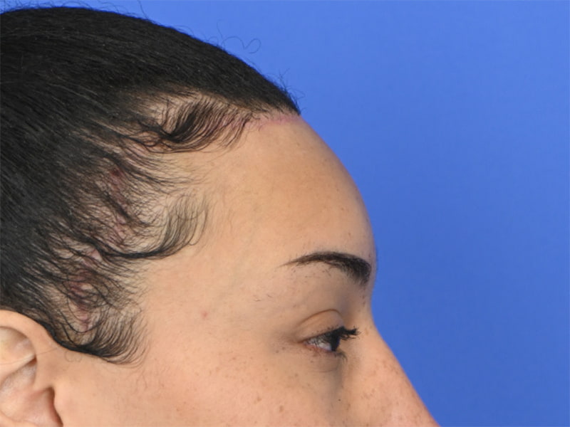 Hairline Advancement Before & After Image