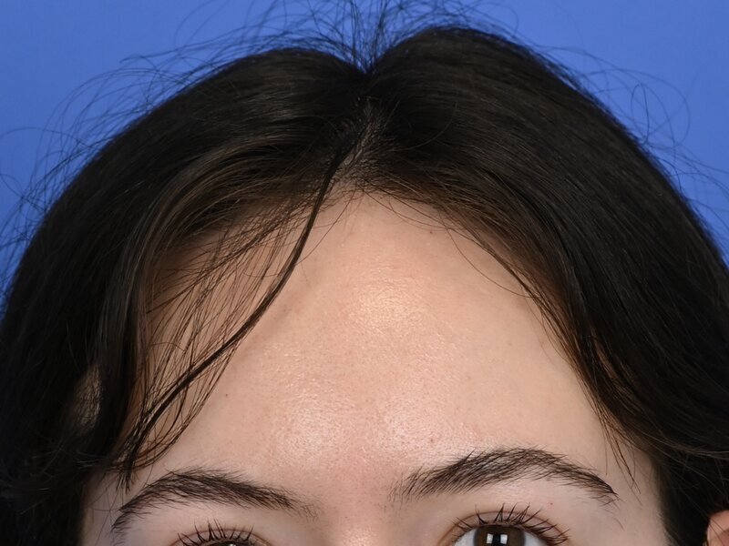 Hairline Advancement Before & After Image