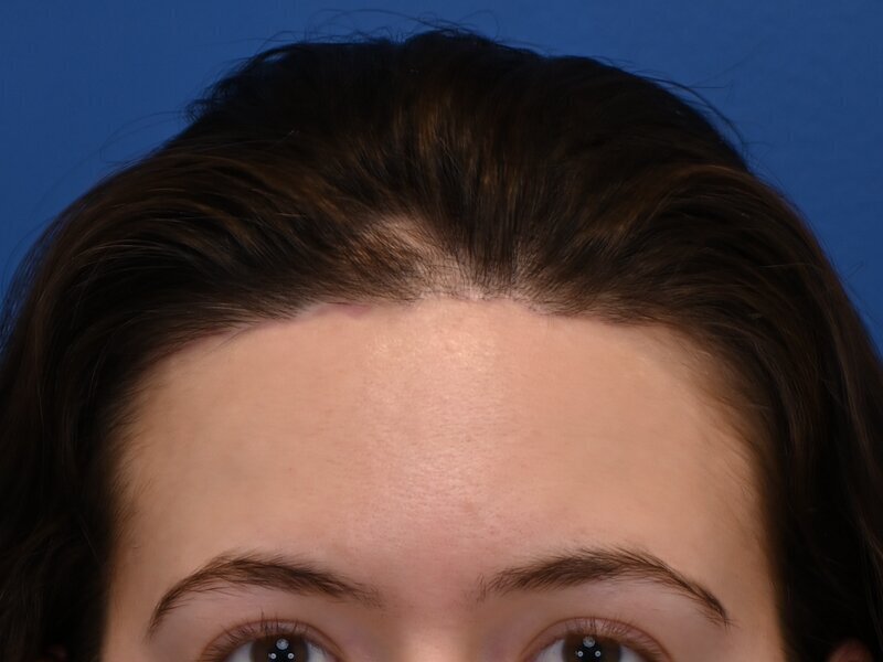 Hairline Advancement Before & After Image