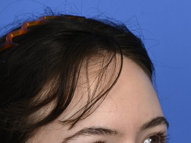 Hairline Advancement Before & After Image