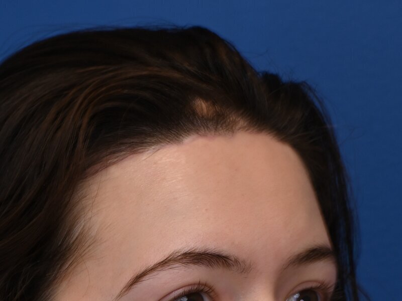 Hairline Advancement Before & After Image
