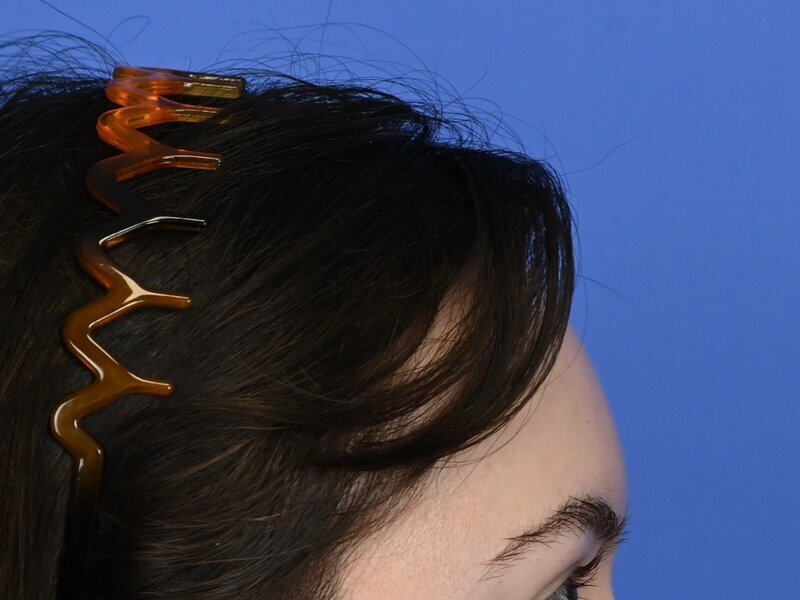 Hairline Advancement Before & After Image