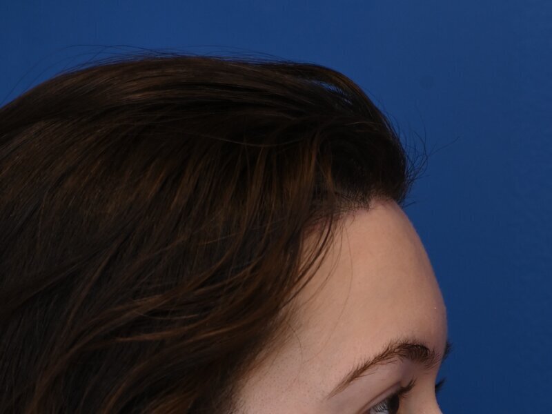 Hairline Advancement Before & After Image