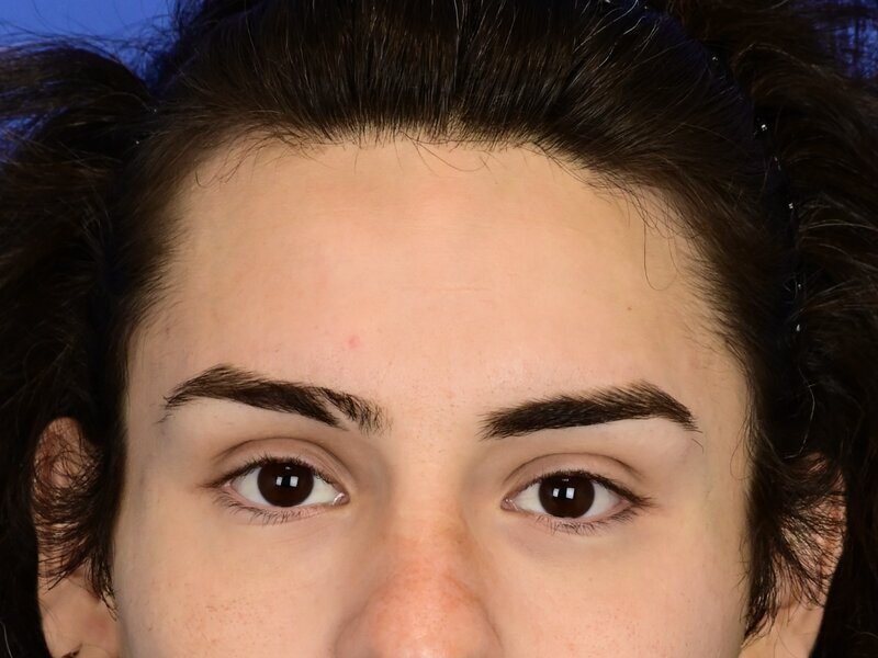 Hairline Advancement Before & After Image