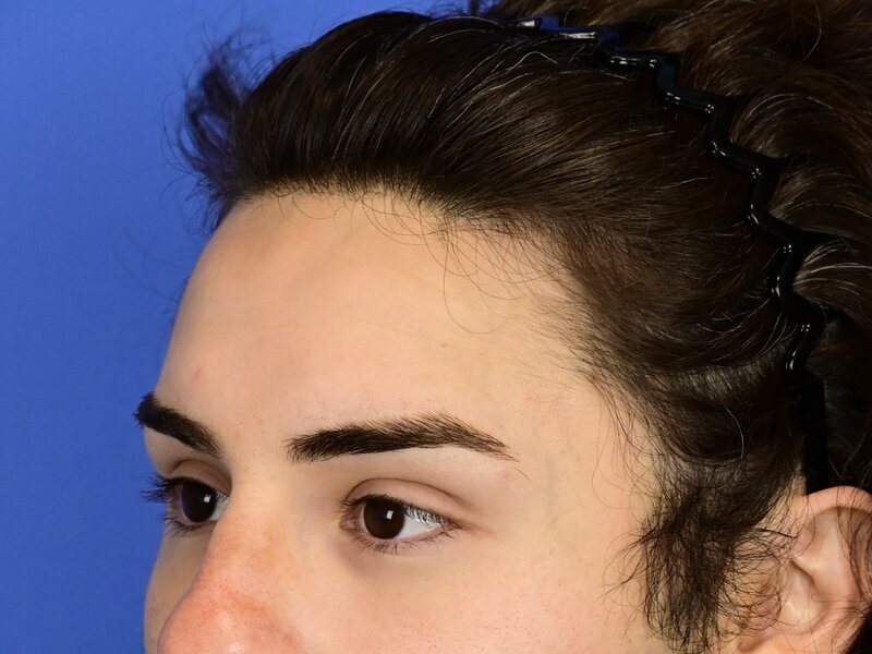 Hairline Advancement Before & After Image