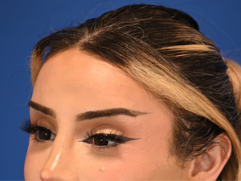 Hairline Advancement Before & After Image
