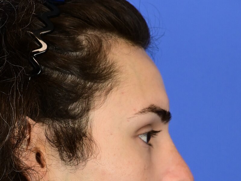 Hairline Advancement Before & After Image