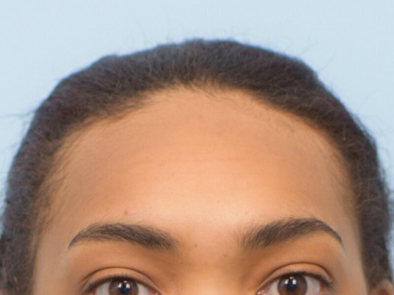 Hairline Advancement Before & After Image