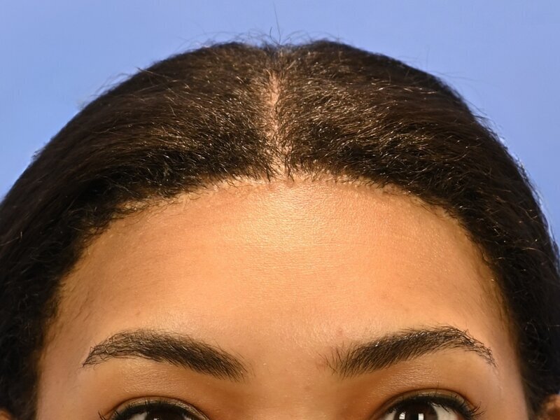 Hairline Advancement Before & After Image