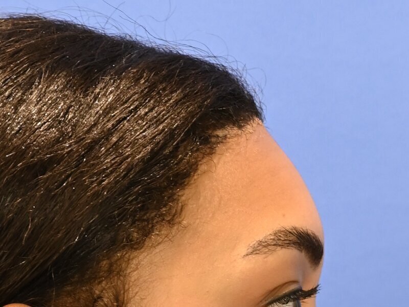 Hairline Advancement Before & After Image