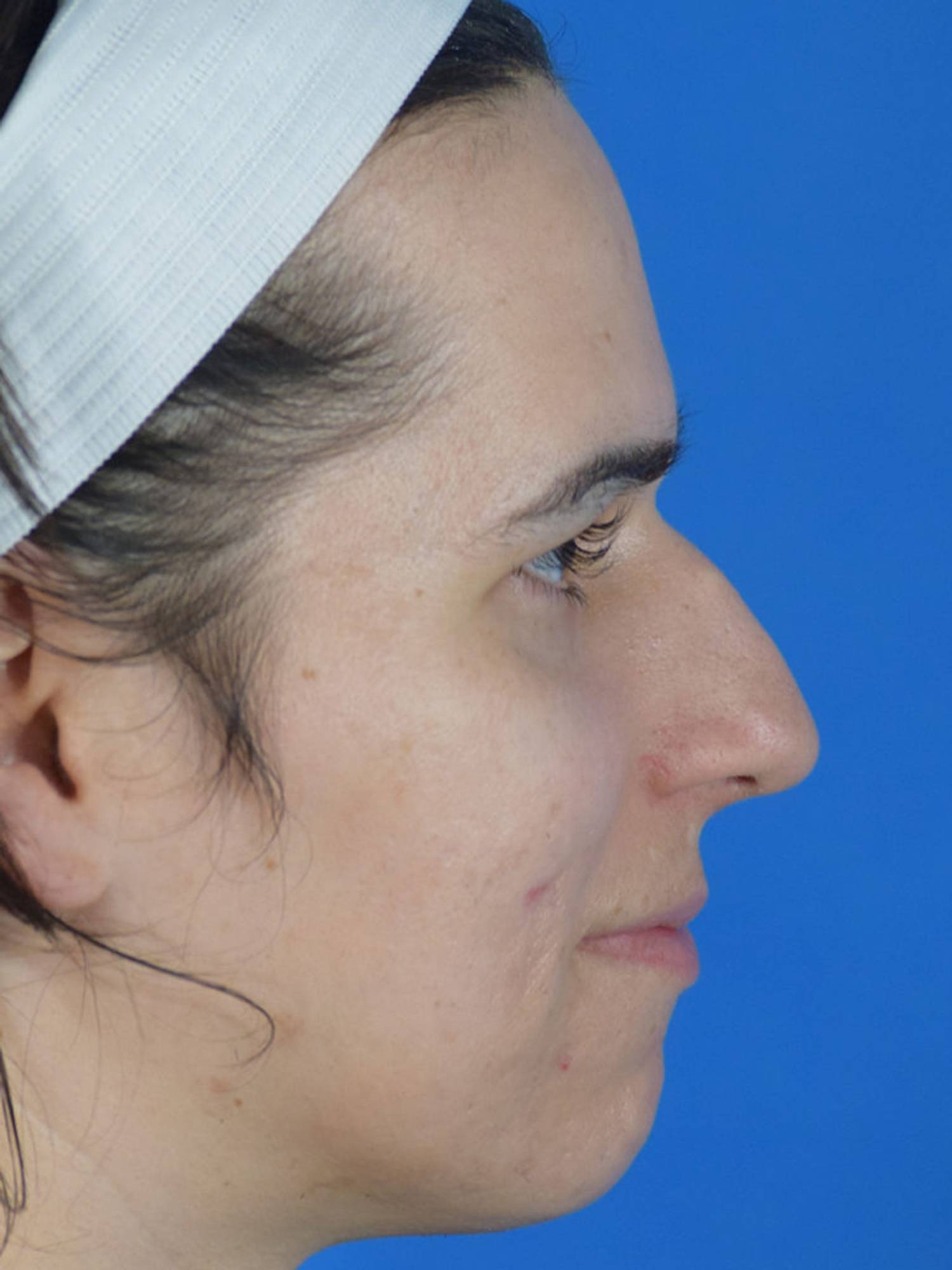 Facial Feminization Surgery Before & After Image