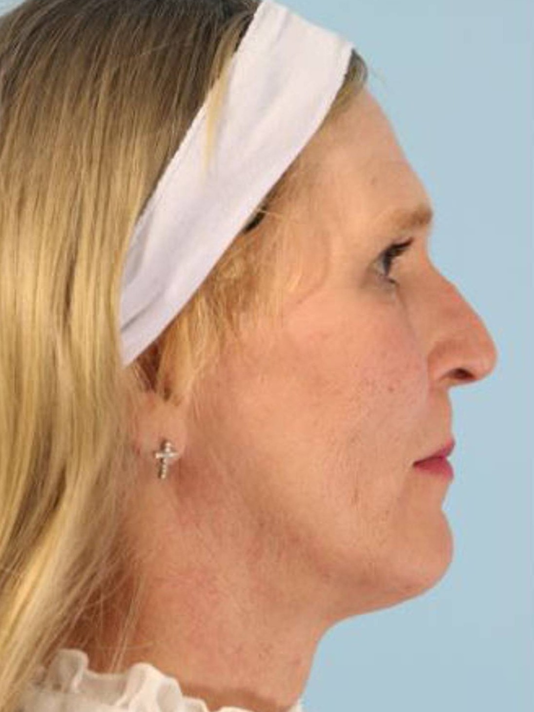 Facial Feminization Surgery Before & After Image