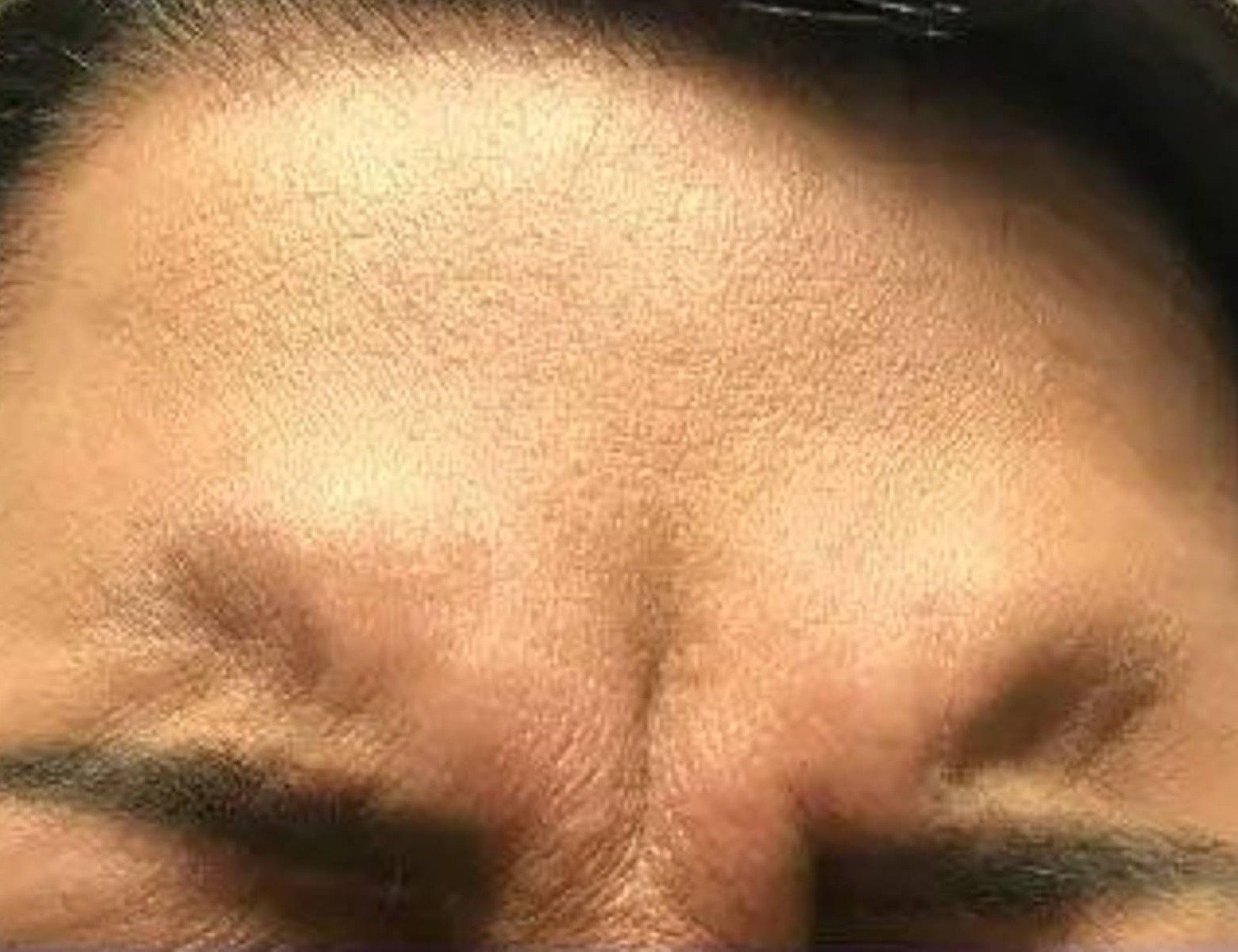 Botox/Dysport Before & After Image