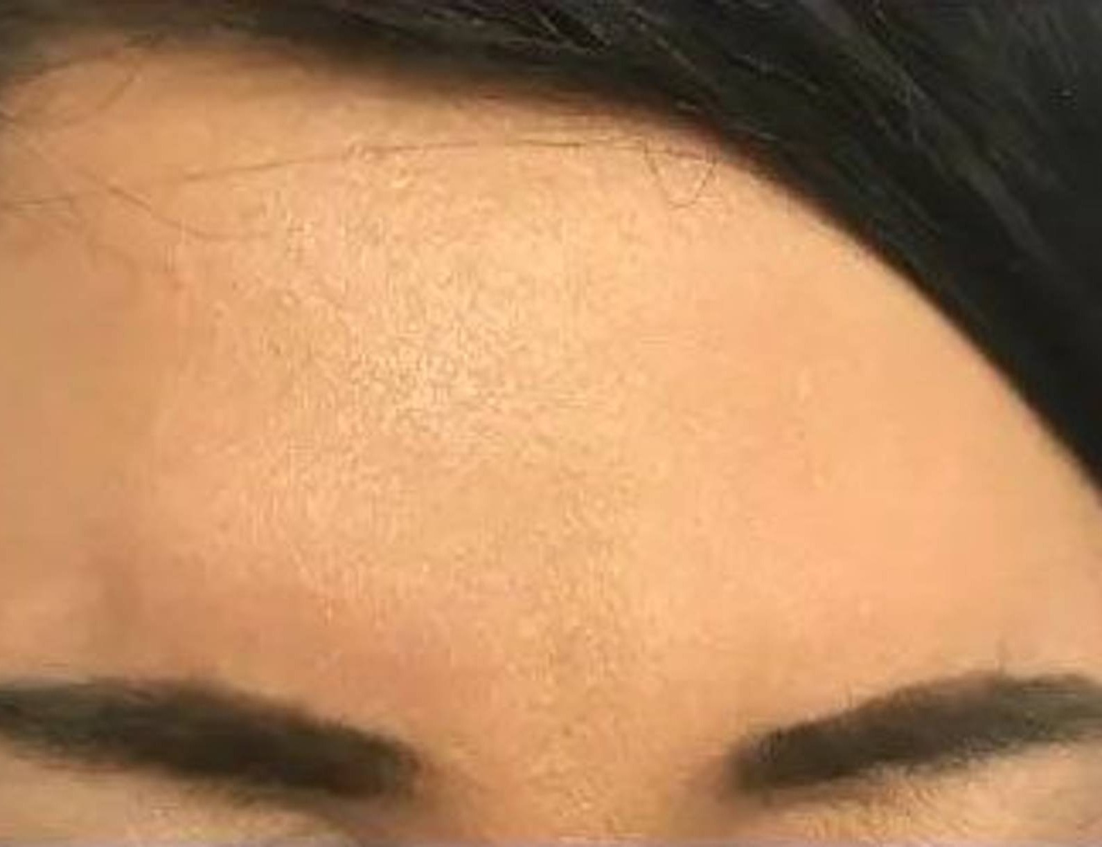 Botox/Dysport Before & After Image