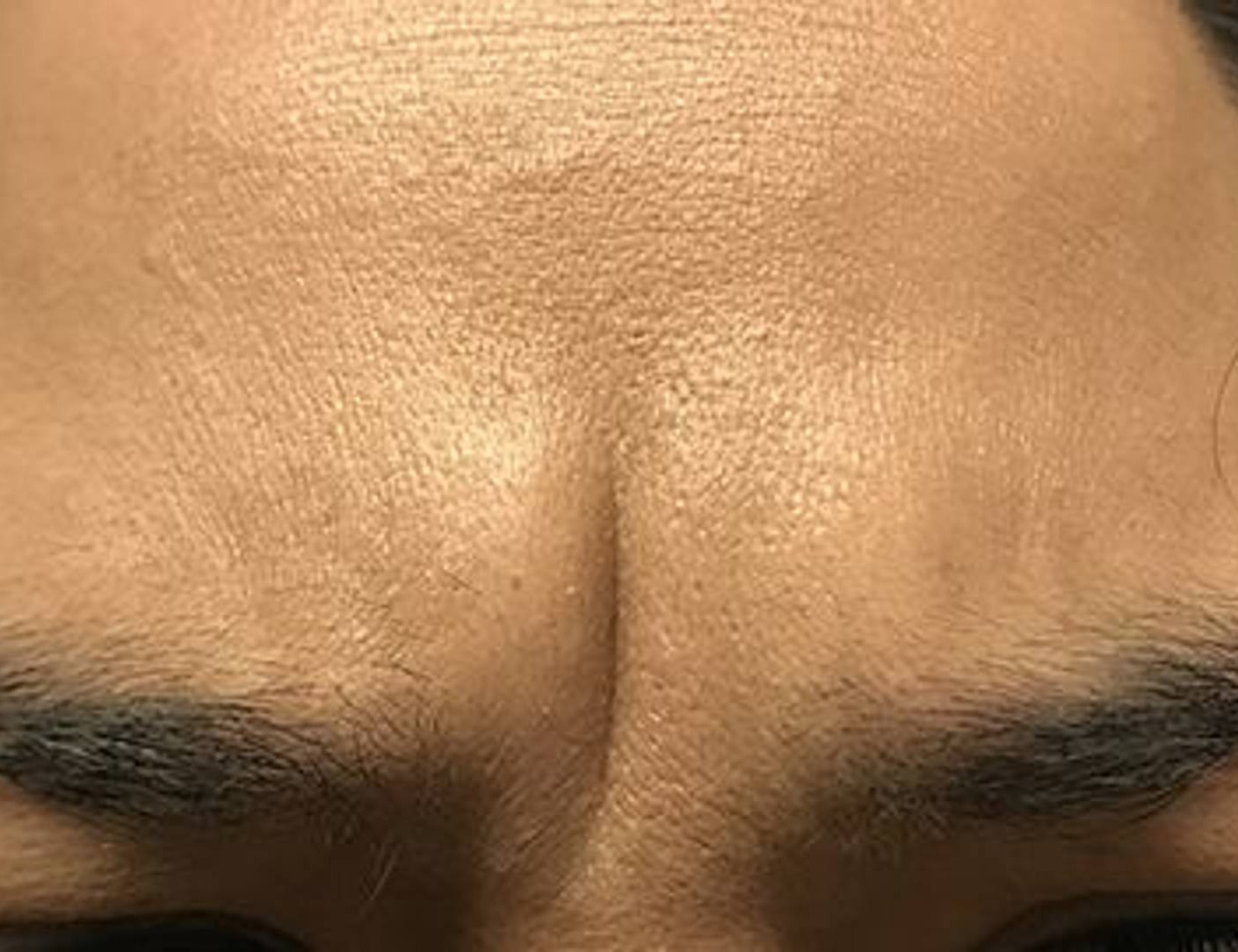 Botox/Dysport Before & After Image