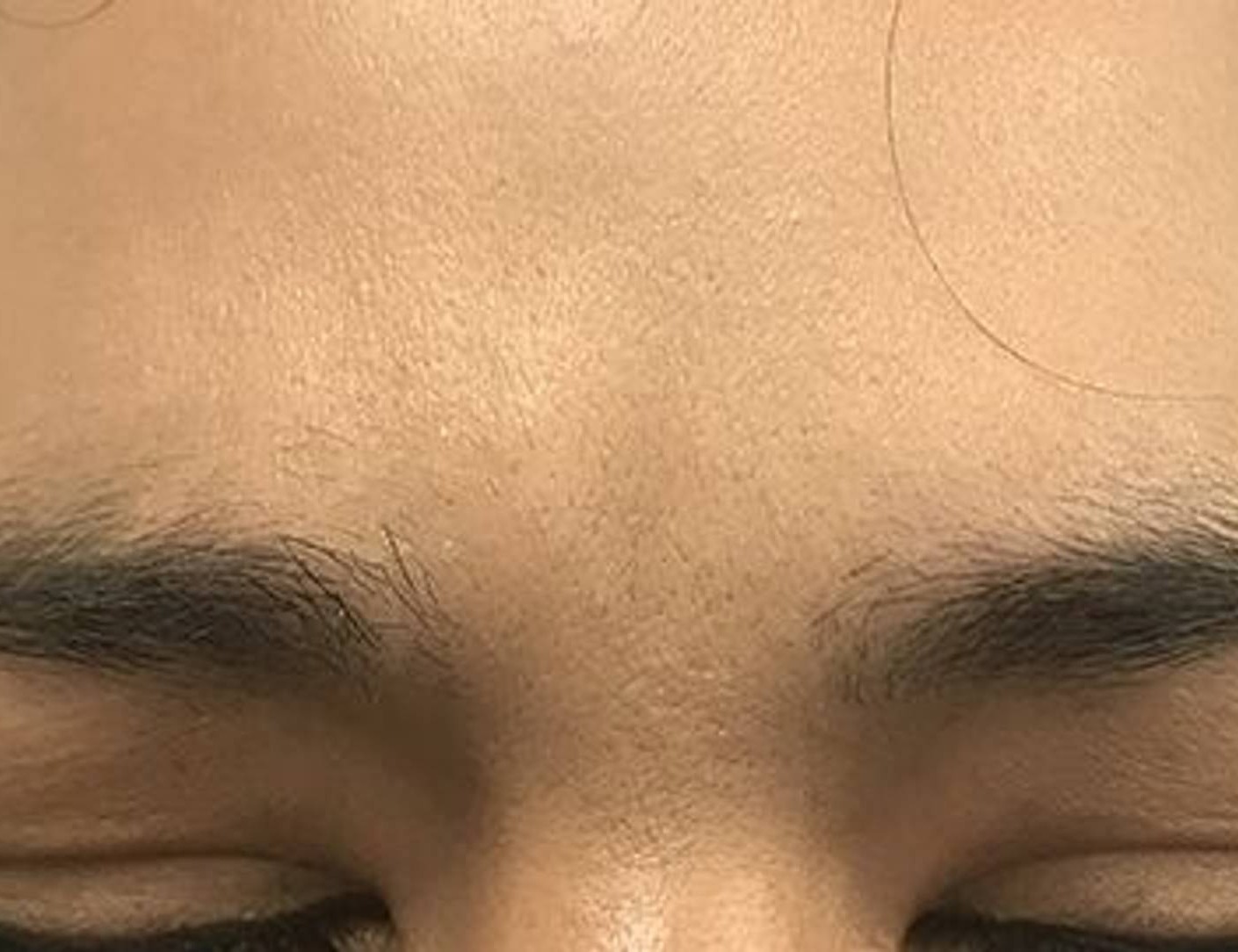 Botox/Dysport Before & After Image