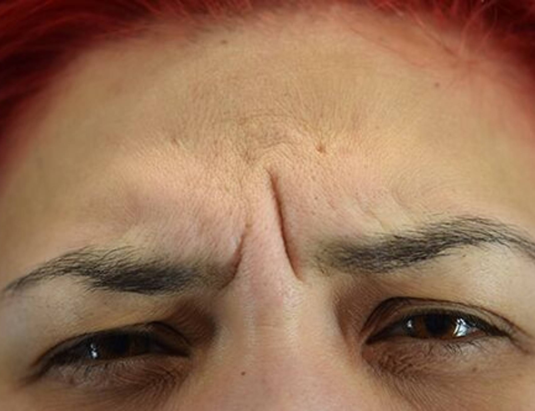 Botox/Dysport Before & After Image