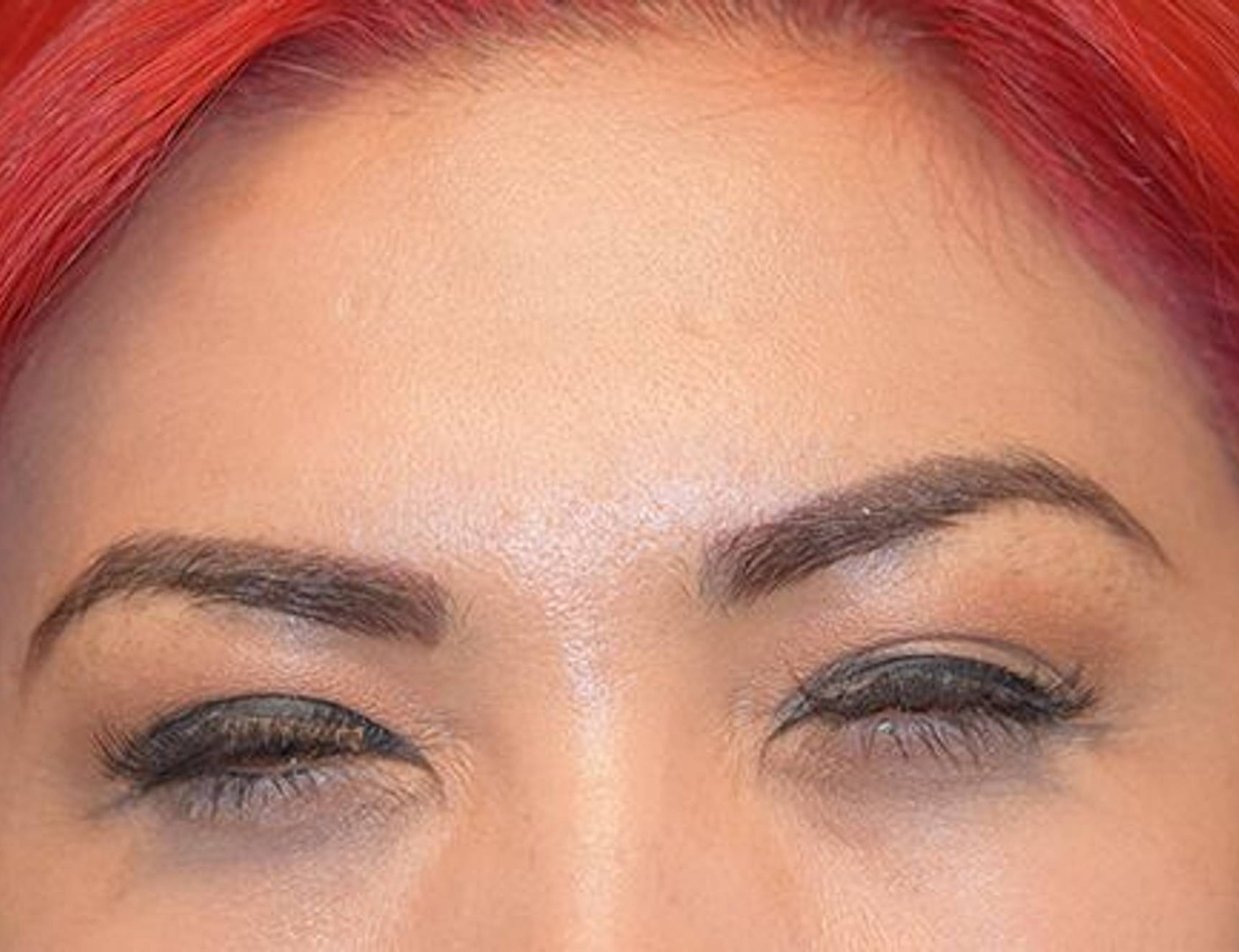 Botox/Dysport Before & After Image